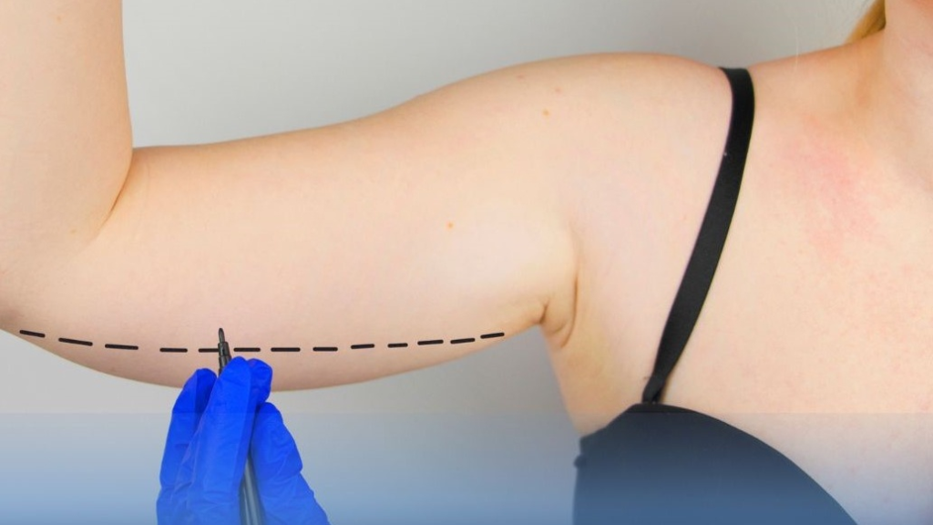 Phẫu Thuật Hút Mỡ Cánh Tay An Toàn – Công Nghệ Microcannulas Tạo Dáng Cánh Tay Thon Gọn (1)