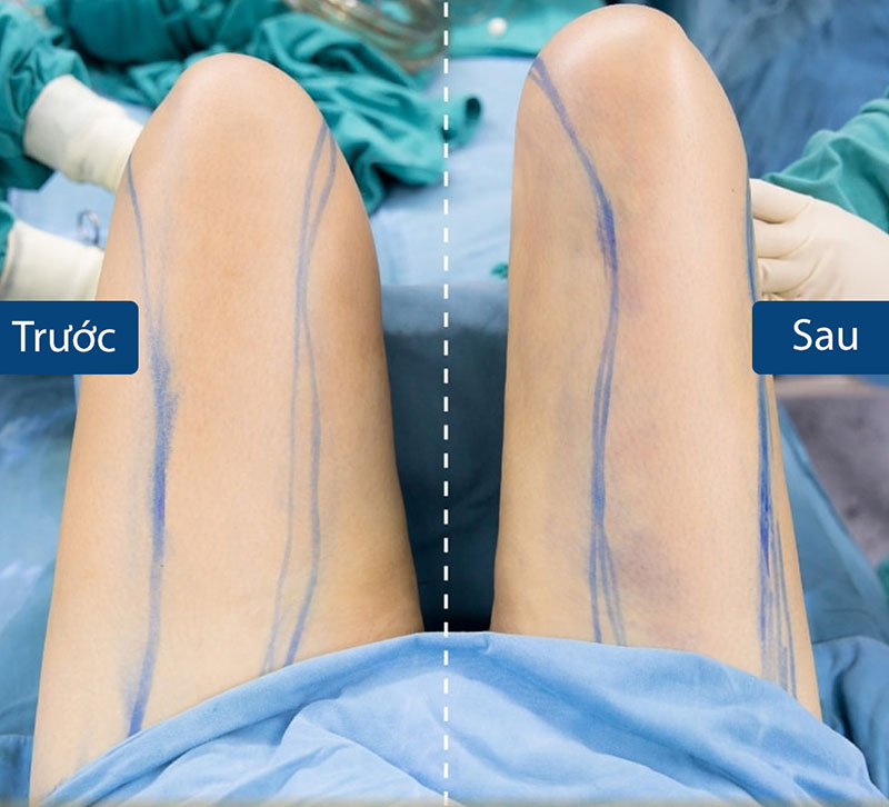 Phau Thuat Hut Mo Dui An Toan – Tao Dang Can Doi Thon Gon Benh Vien Tham My HATY 1