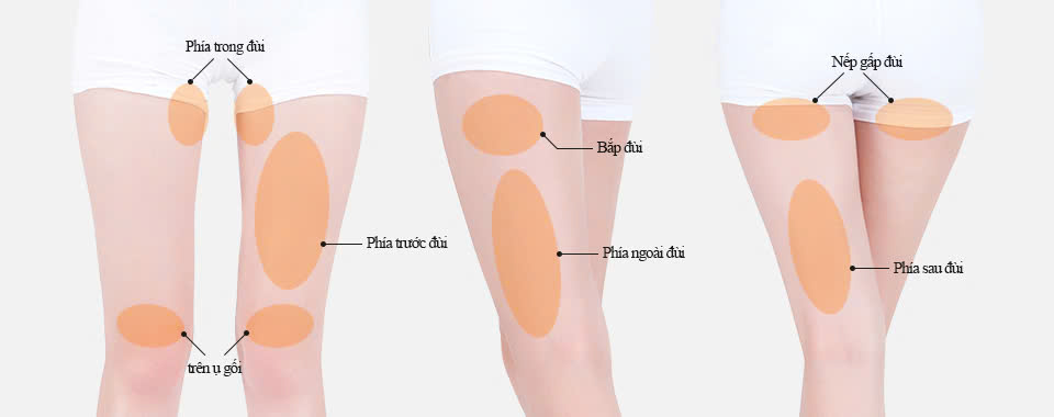 Phẫu Thuật Hút Mỡ Đùi An Toàn – Tạo Dáng Cân Đối & Thon Gọn Bệnh Viện Thẩm Mỹ HATY (3)