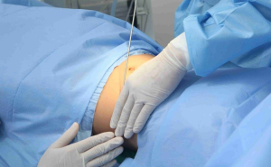 Phau Thuat Hut Mo Liposuction An Toan – Ky Thuat Tumescent Microcannula 3