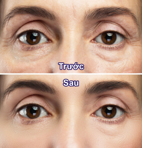 Phau Thuat Tham My Vung Mat Cat Mi Lay Mo Tao Hinh Mi Mat – Benh Vien Tham My HATY 2