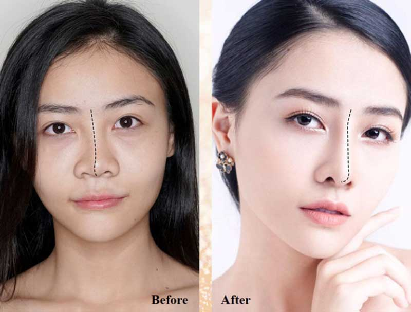 Phau Thuat Tham My Vung Mui – Nang Mui Thu Gon Keo Dai Chuan Y Khoa 3